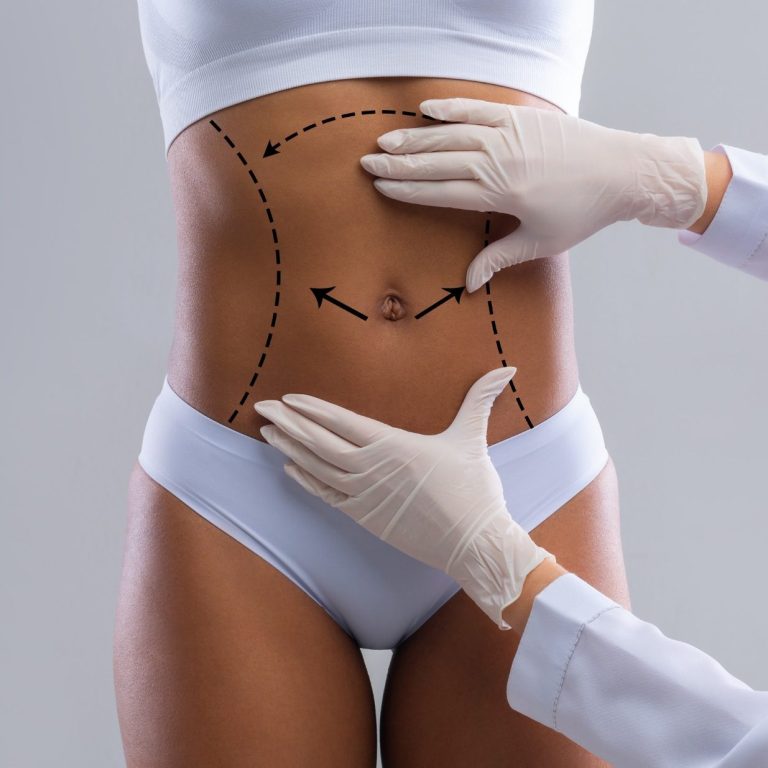 Behandlung des Bauches mit Markierungen und Händen eines Arztes in Handschuhen.
